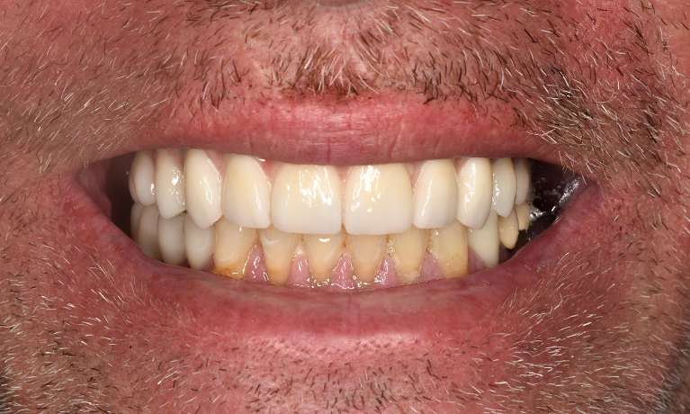 An after image of teeth after a dental implant in Pacifica, CA