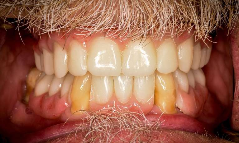 Nederland family dental patient after receiving dental implants