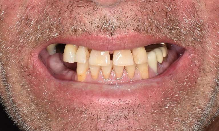 An image before getting dental implants in Pacifica, CA