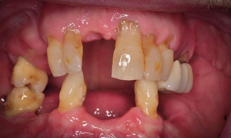 A patient before receiving dental implants